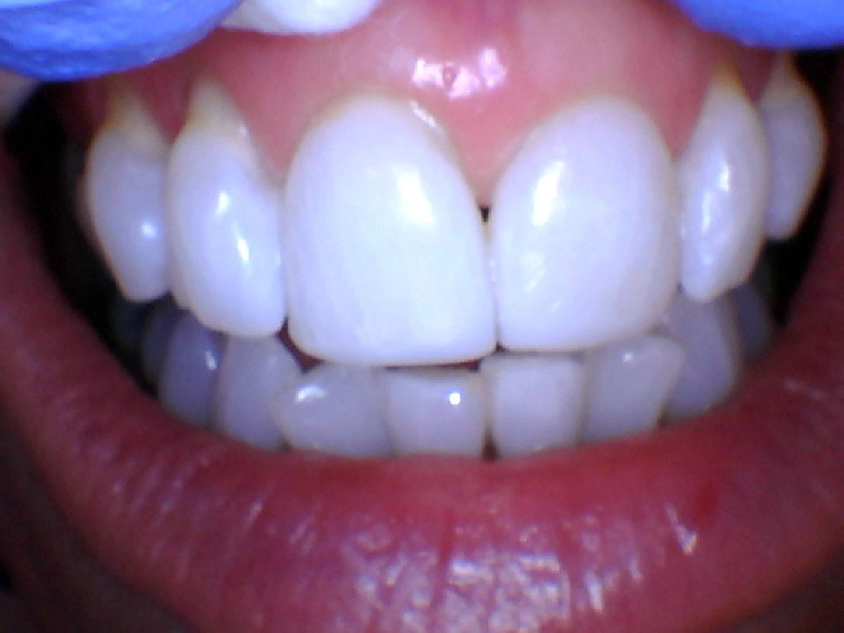 Worn teeth