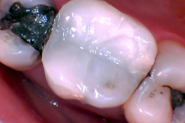 White fillings after