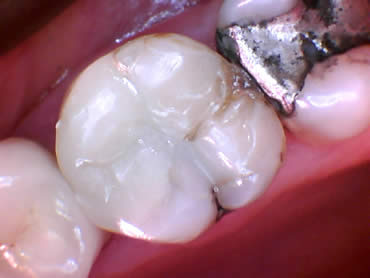 Fillings After